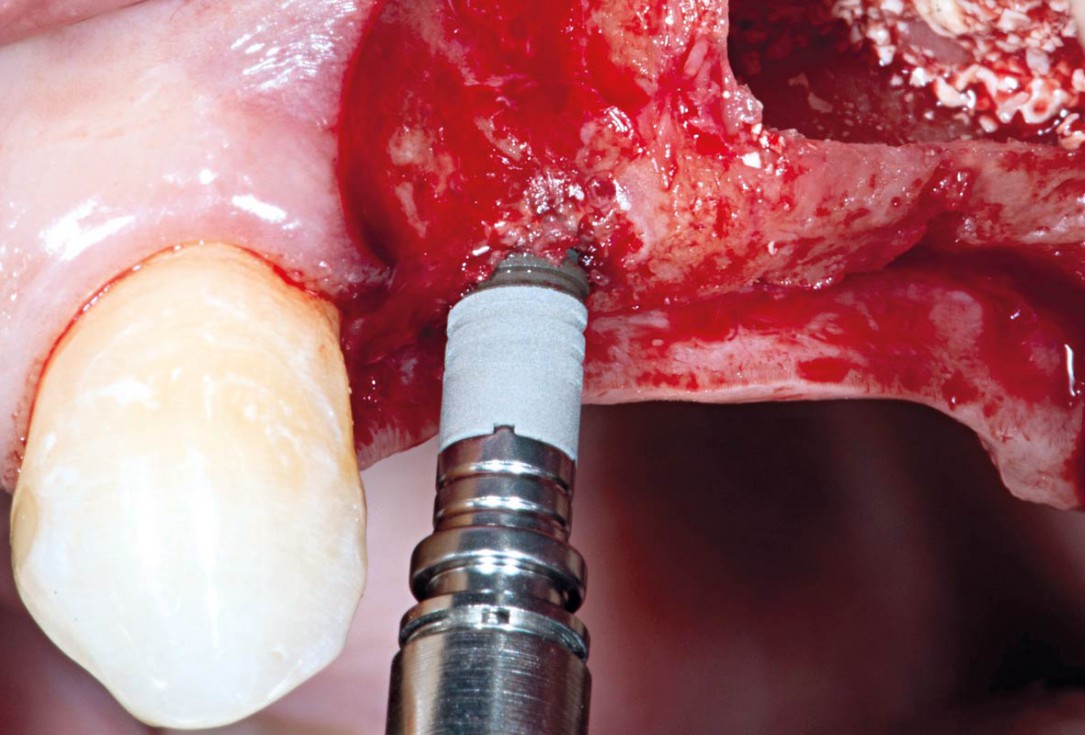 Sinus Floor Elevation with maxgraft® bonering and subcrestal implantation in an eggshell thin sinus - Dr. K. Chmielewski