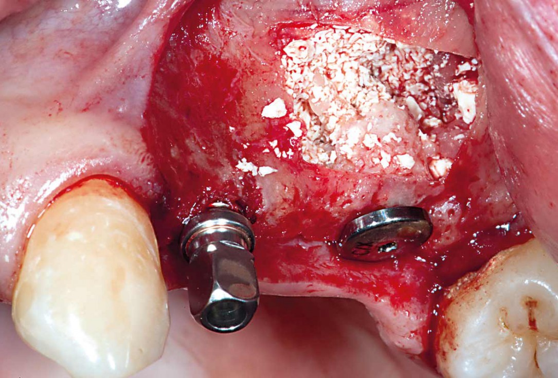 Sinus Floor Elevation with maxgraft® bonering and subcrestal implantation in an eggshell thin sinus - Dr. K. Chmielewski