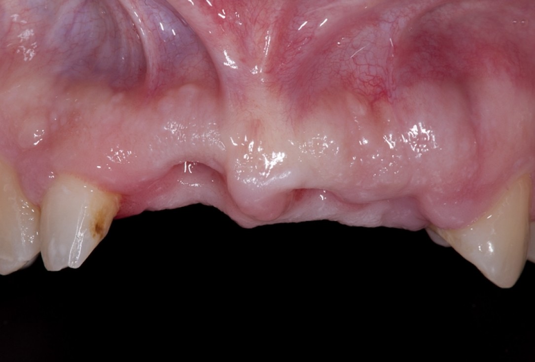 Socket preservation with collacone® - Dr. K. Chmielewski