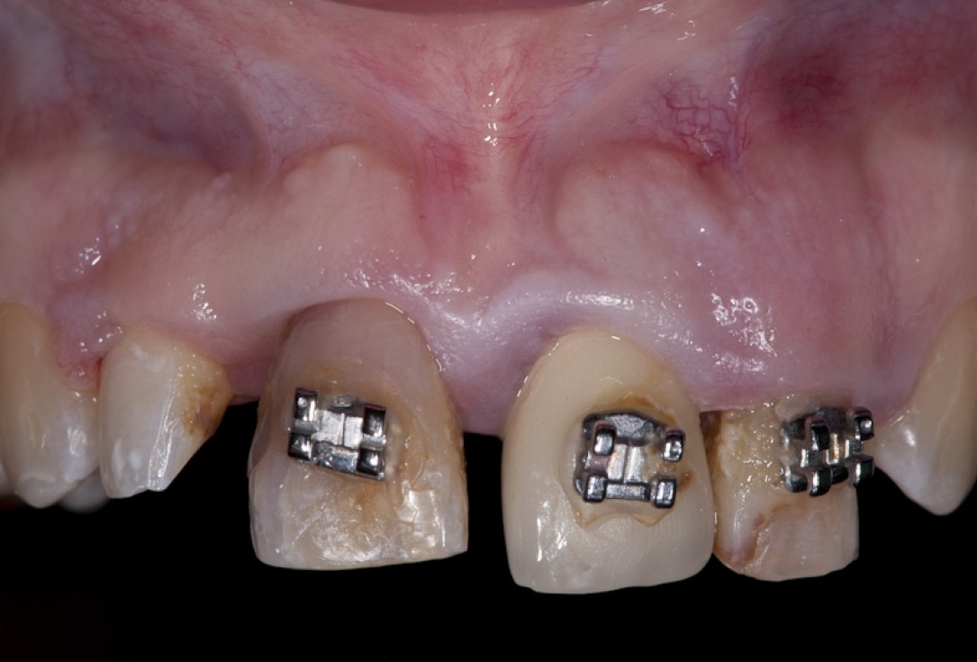 Socket preservation with collacone® - Dr. K. Chmielewski