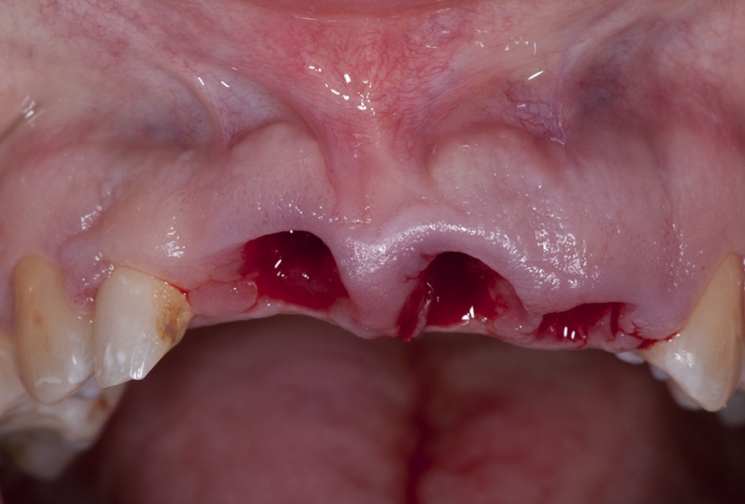 Socket preservation with collacone® - Dr. K. Chmielewski