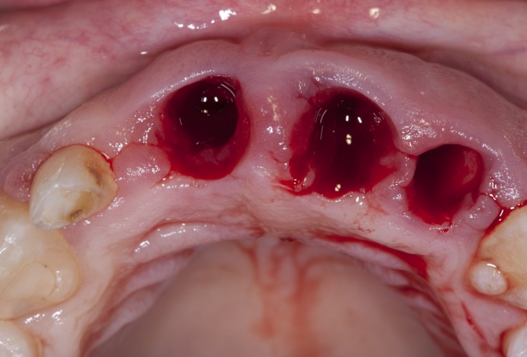 Socket preservation with collacone® - Dr. K. Chmielewski