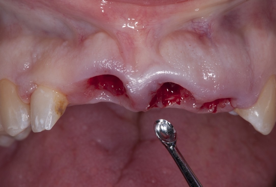 Socket preservation with collacone® - Dr. K. Chmielewski