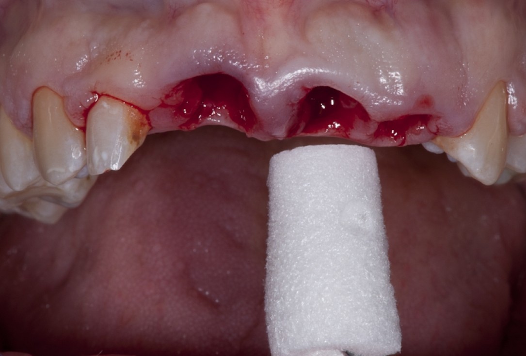 Socket preservation with collacone® - Dr. K. Chmielewski