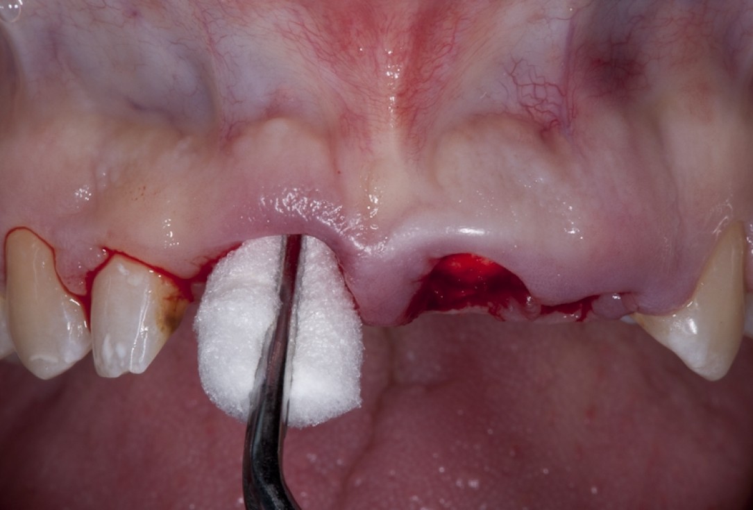 Socket preservation with collacone® - Dr. K. Chmielewski