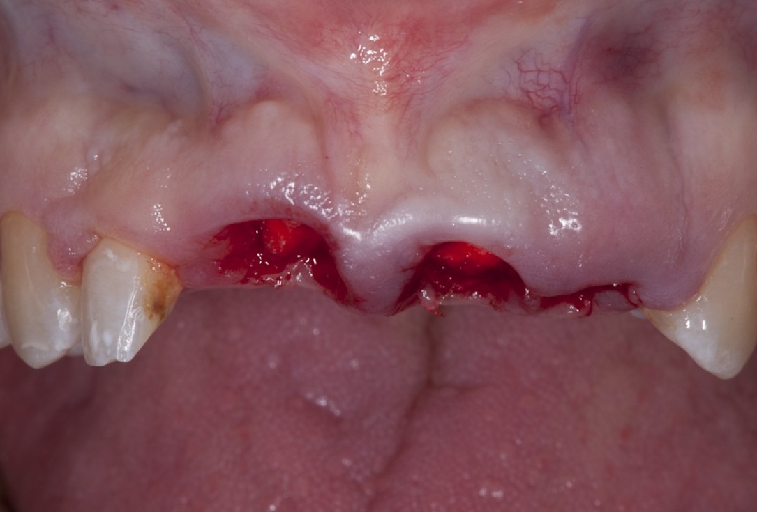 Socket preservation with collacone® - Dr. K. Chmielewski