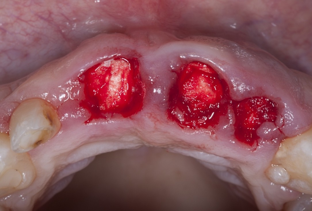 Socket preservation with collacone® - Dr. K. Chmielewski