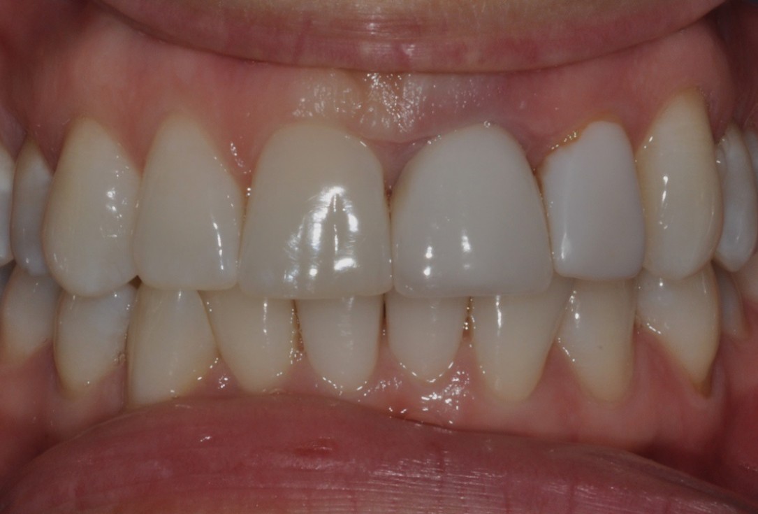 Socket preservation with cerabone® - Dr. Rahib Adi Nader