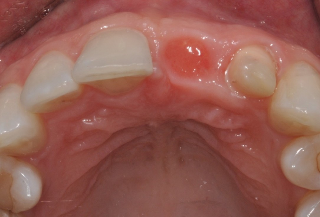 Socket preservation with cerabone® - Dr. Rahib Adi Nader