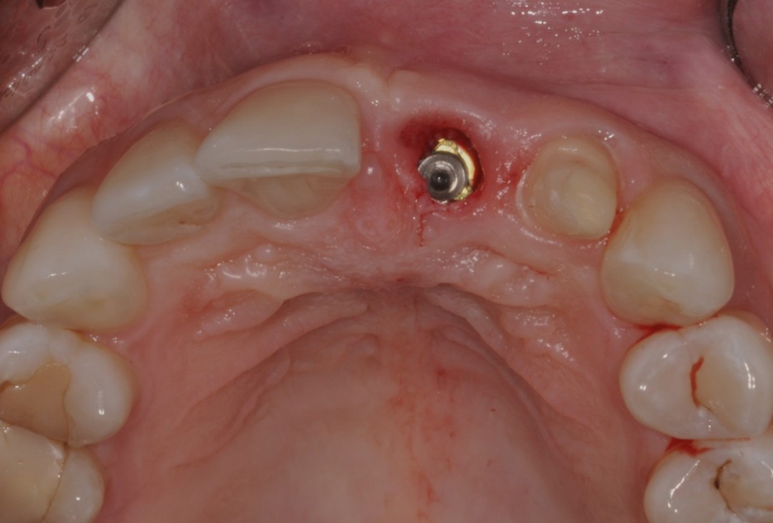 Socket preservation with cerabone® - Dr. Rahib Adi Nader