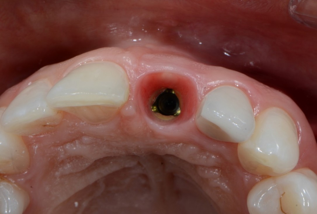 Socket preservation with cerabone® - Dr. Rahib Adi Nader