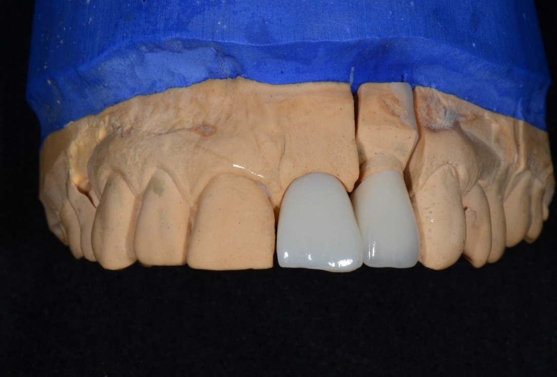 Socket preservation with cerabone® - Dr. Rahib Adi Nader