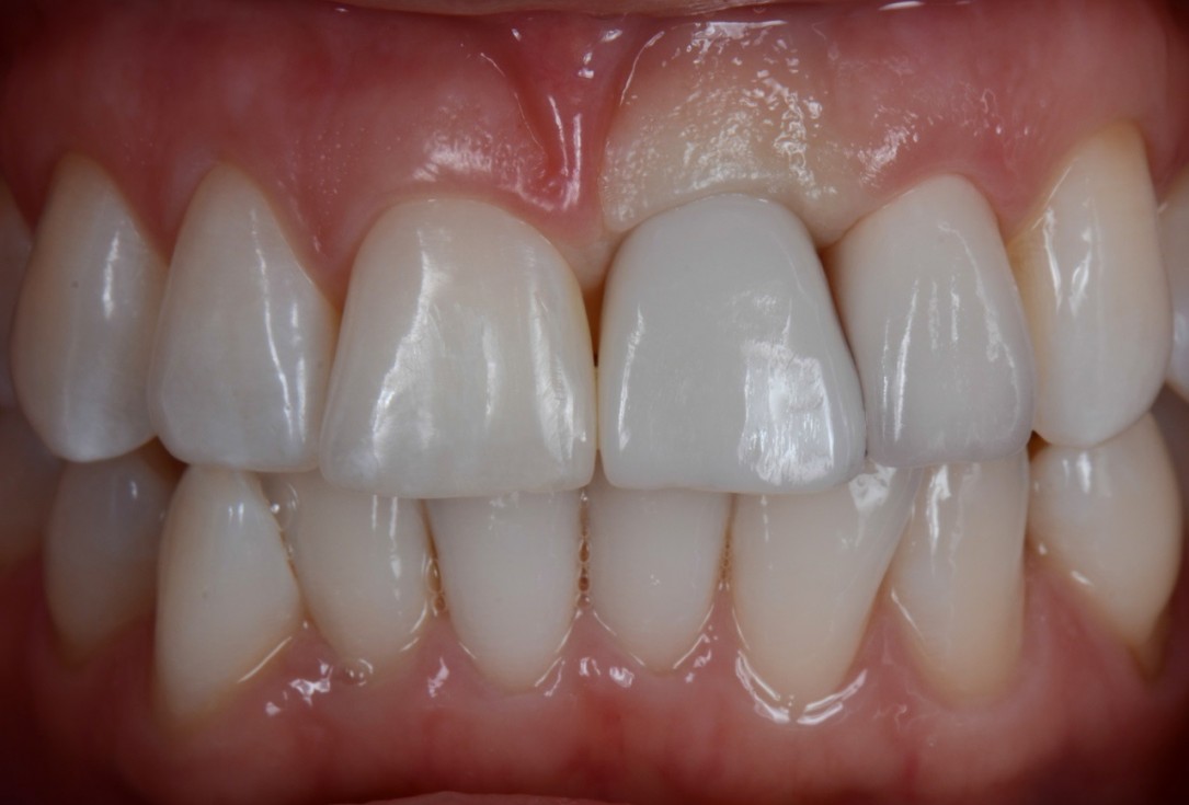 Socket preservation with cerabone® - Dr. Rahib Adi Nader