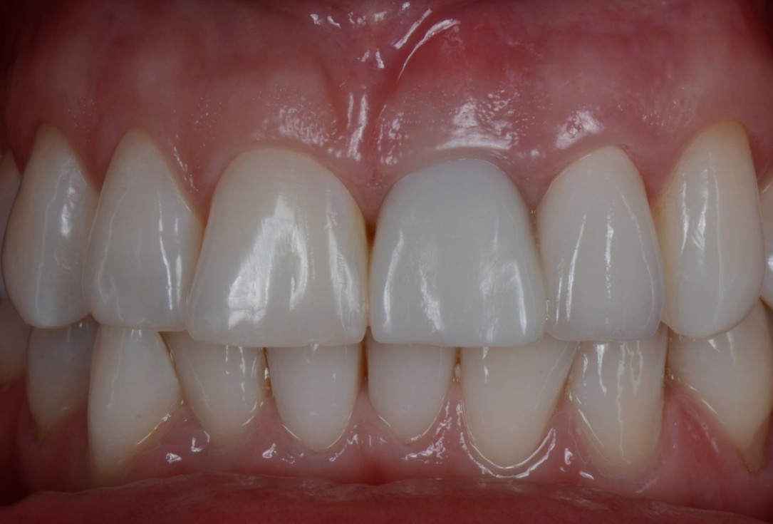 Socket preservation with cerabone® - Dr. Rahib Adi Nader