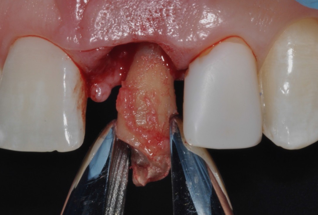 Socket preservation with cerabone® - Dr. Rahib Adi Nader