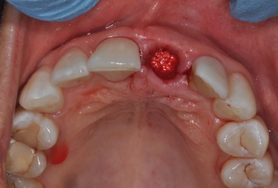 Socket preservation with cerabone® - Dr. Rahib Adi Nader