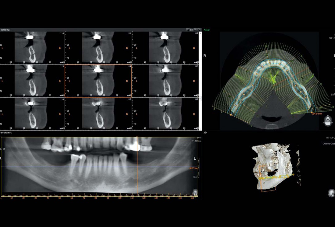 Shell Technique with augmentative relining with cerabone® and Jason® membrane (Split Mouth with maxgraft® cortico and autologous bone plates) - Dr. J. Tunkel