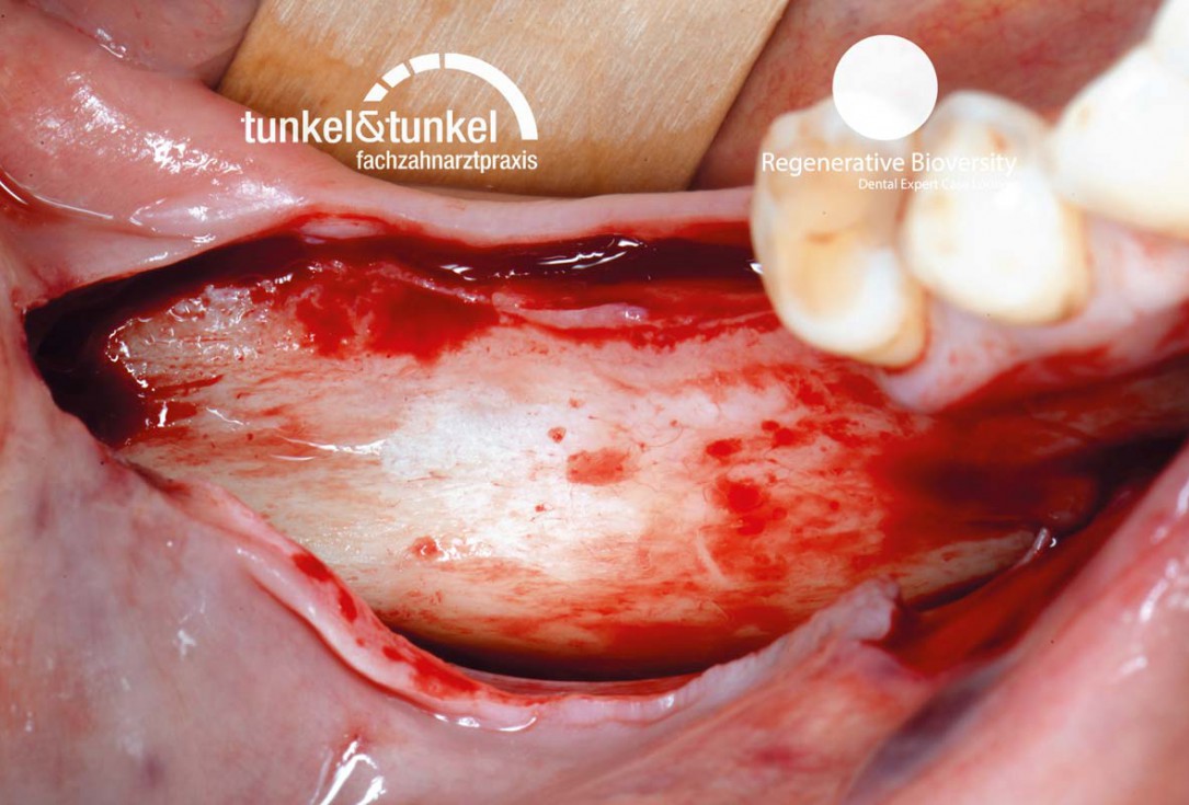 Shell Technique with augmentative relining with cerabone® and Jason® membrane (Split Mouth with maxgraft® cortico and autologous bone plates) - Dr. J. Tunkel