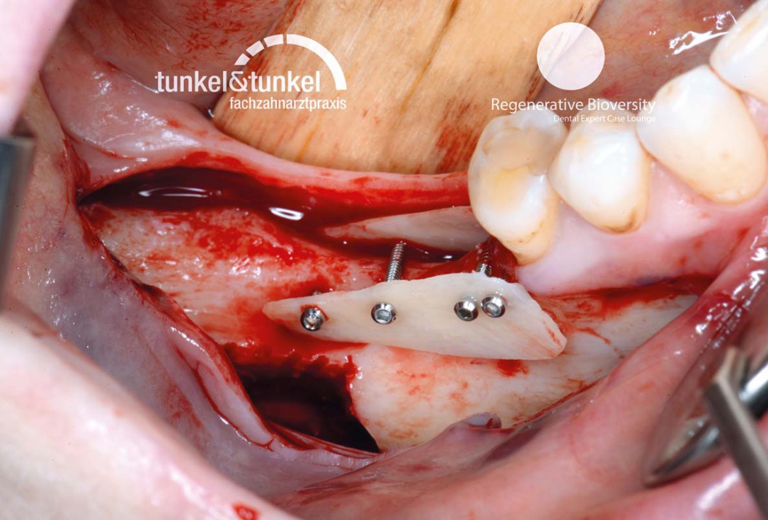 Shell Technique with augmentative relining with cerabone® and Jason® membrane (Split Mouth with maxgraft® cortico and autologous bone plates) - Dr. J. Tunkel