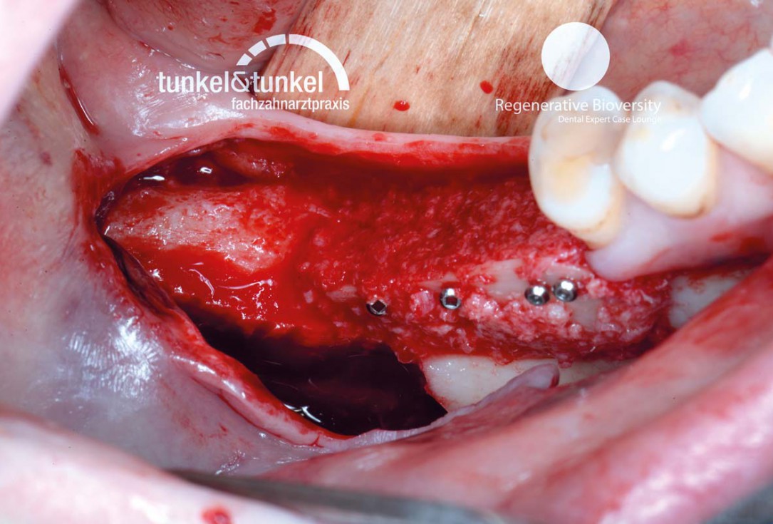 Shell Technique with augmentative relining with cerabone® and Jason® membrane (Split Mouth with maxgraft® cortico and autologous bone plates) - Dr. J. Tunkel