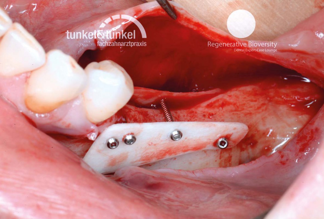 Shell Technique with augmentative relining with cerabone® and Jason® membrane (Split Mouth with maxgraft® cortico and autologous bone plates) - Dr. J. Tunkel