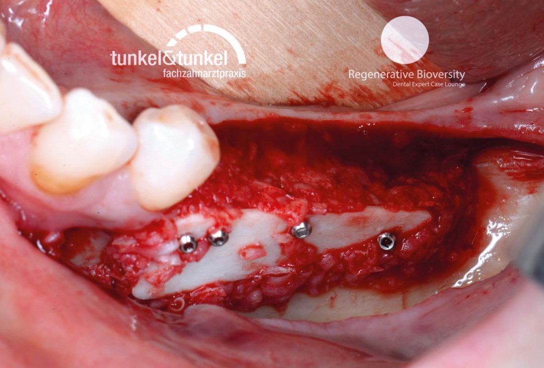 Shell Technique with augmentative relining with cerabone® and Jason® membrane (Split Mouth with maxgraft® cortico and autologous bone plates) - Dr. J. Tunkel