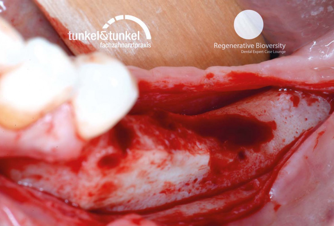 Shell Technique with augmentative relining with cerabone® and Jason® membrane (Split Mouth with maxgraft® cortico and autologous bone plates) - Dr. J. Tunkel