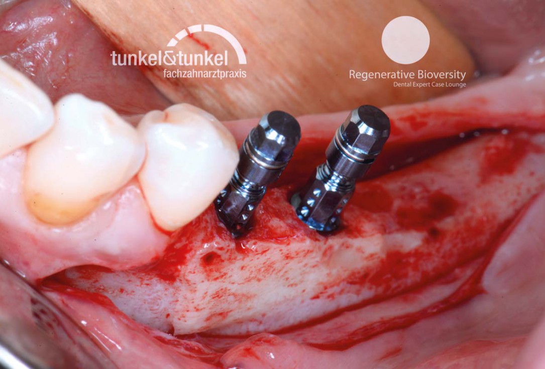 Shell Technique with augmentative relining with cerabone® and Jason® membrane (Split Mouth with maxgraft® cortico and autologous bone plates) - Dr. J. Tunkel