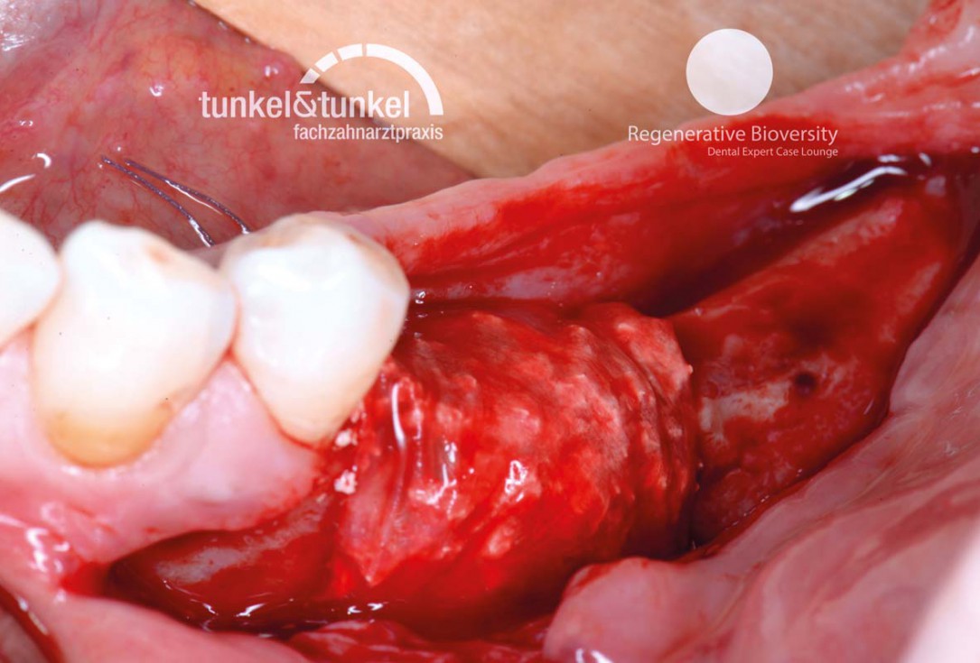 Shell Technique with augmentative relining with cerabone® and Jason® membrane (Split Mouth with maxgraft® cortico and autologous bone plates) - Dr. J. Tunkel