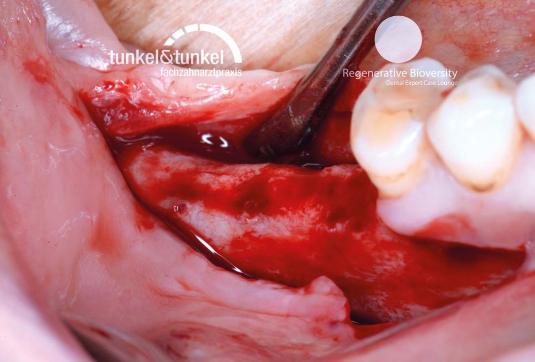 Shell Technique with augmentative relining with cerabone® and Jason® membrane (Split Mouth with maxgraft® cortico and autologous bone plates) - Dr. J. Tunkel