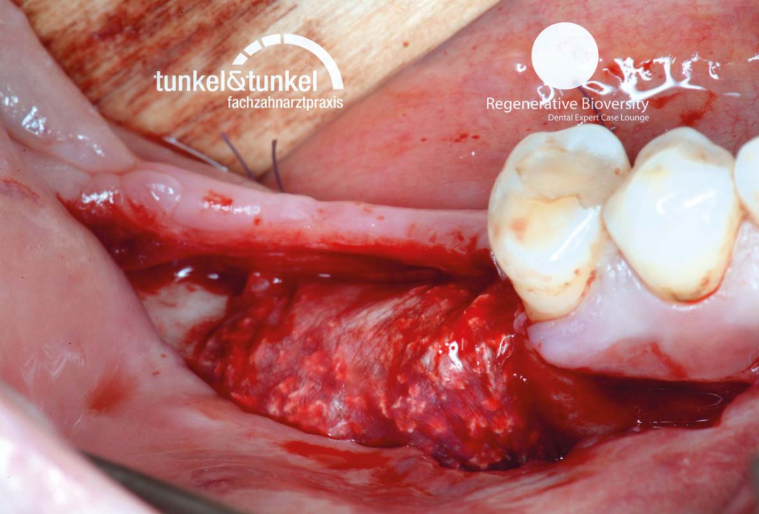 Shell Technique with augmentative relining with cerabone® and Jason® membrane (Split Mouth with maxgraft® cortico and autologous bone plates) - Dr. J. Tunkel