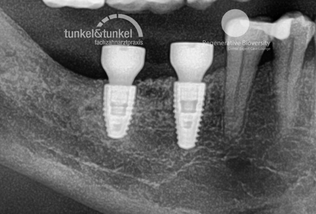 Shell Technique with augmentative relining with cerabone® and Jason® membrane (Split Mouth with maxgraft® cortico and autologous bone plates) - Dr. J. Tunkel