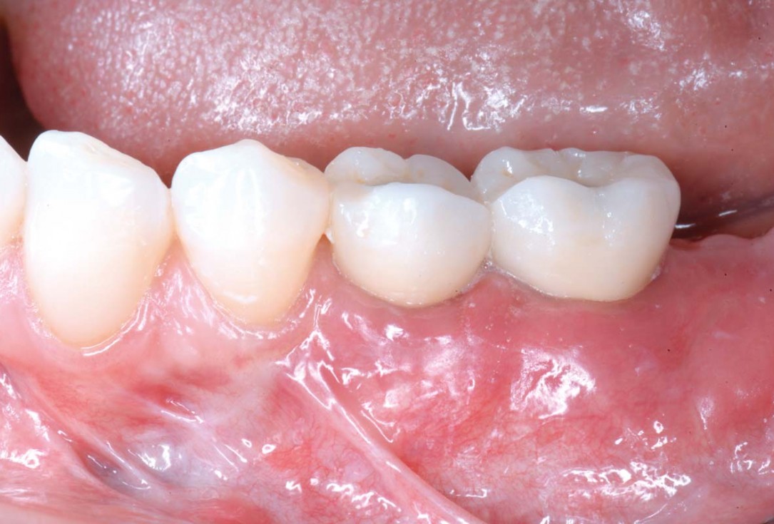 Shell Technique with augmentative relining with cerabone® and Jason® membrane (Split Mouth with maxgraft® cortico and autologous bone plates) - Dr. J. Tunkel