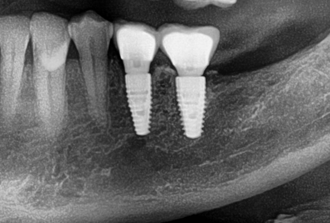 Shell Technique with augmentative relining with cerabone® and Jason® membrane (Split Mouth with maxgraft® cortico and autologous bone plates) - Dr. J. Tunkel