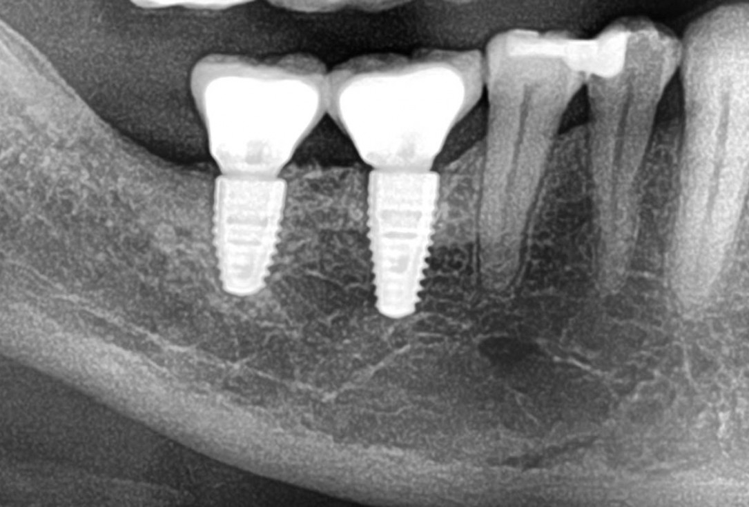 Shell Technique with augmentative relining with cerabone® and Jason® membrane (Split Mouth with maxgraft® cortico and autologous bone plates) - Dr. J. Tunkel