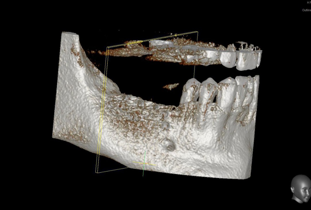 Three-dimensional augmentation with maxgraft® cortico - Dr. R. Würdinger
