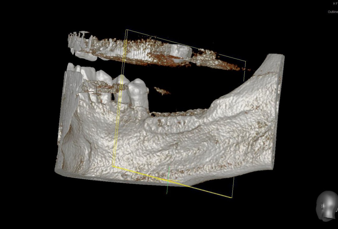 Three-dimensional augmentation with maxgraft® cortico - Dr. R. Würdinger