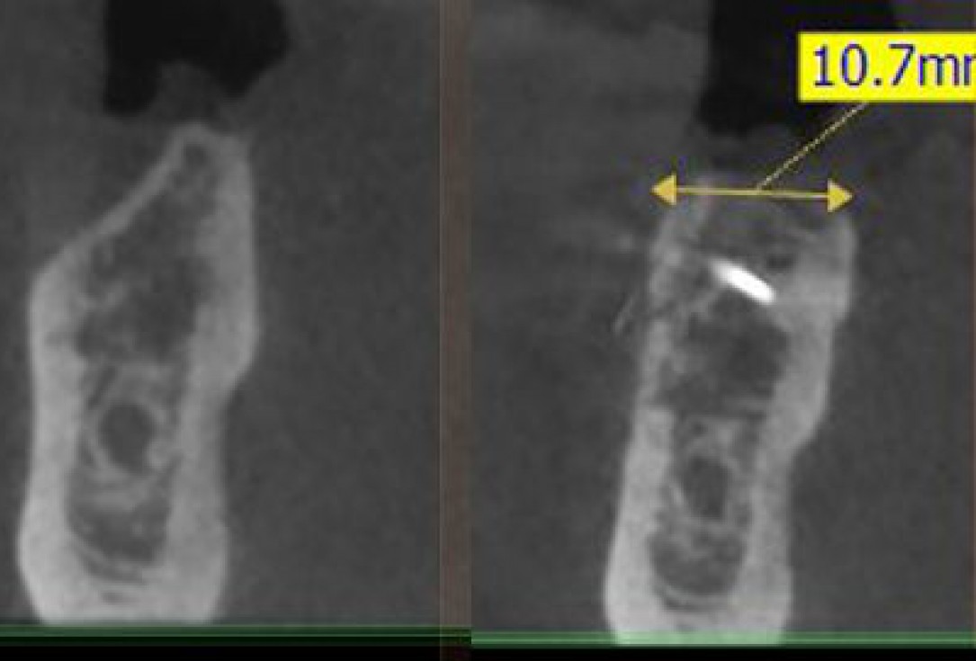 Three-dimensional augmentation with maxgraft® cortico - Dr. R. Würdinger