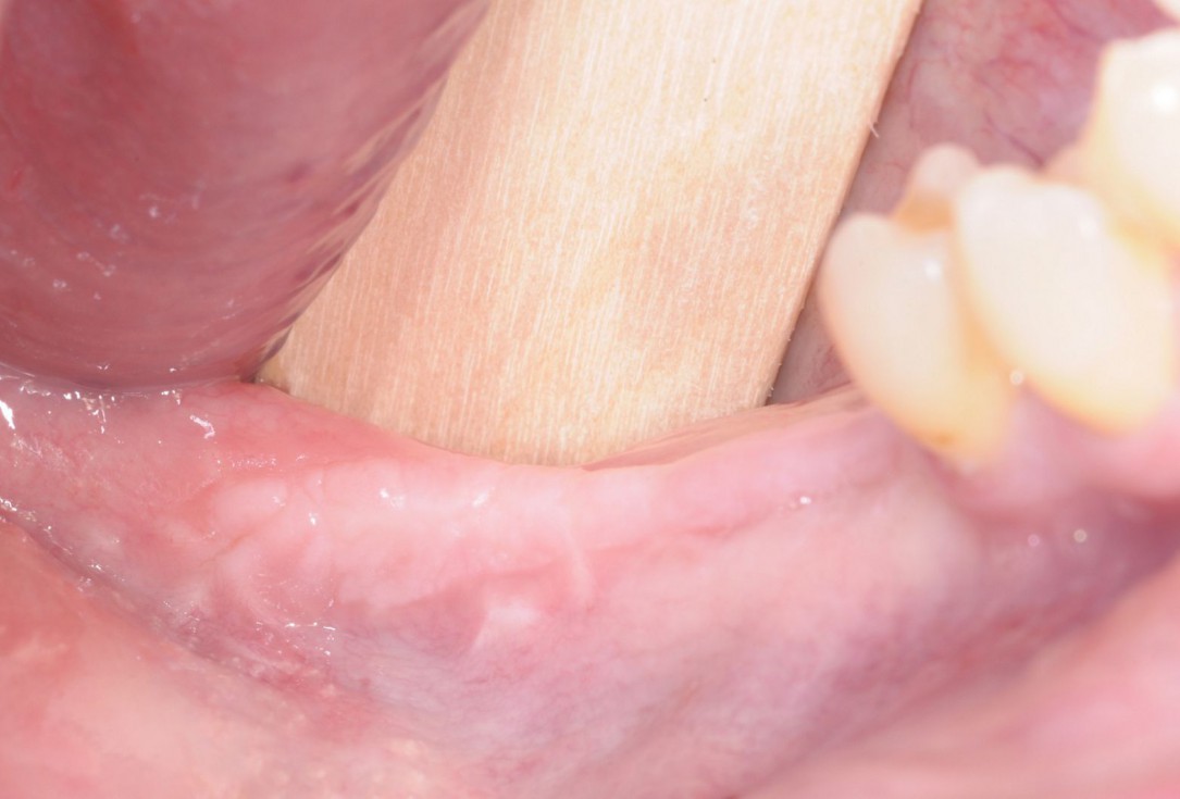 Three-dimensional augmentation with maxgraft® cortico - Dr. R. Würdinger