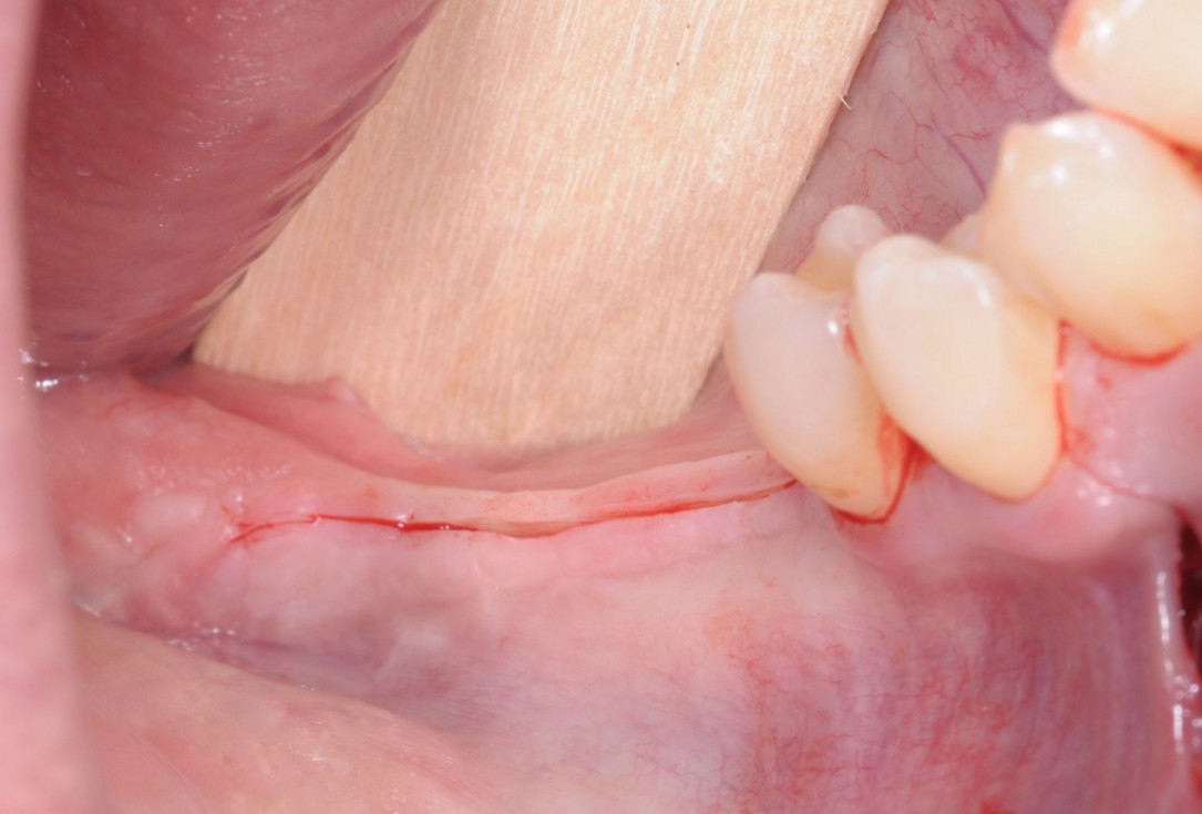 Three-dimensional augmentation with maxgraft® cortico - Dr. R. Würdinger