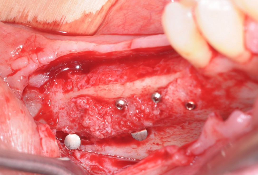 Three-dimensional augmentation with maxgraft® cortico - Dr. R. Würdinger