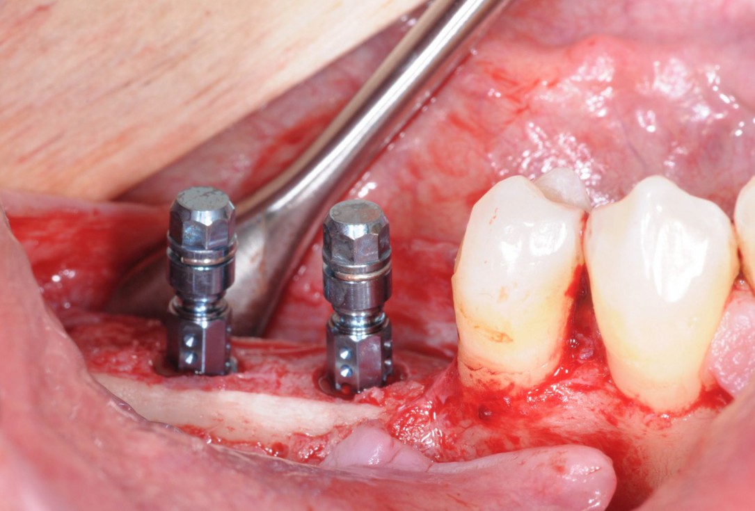 Three-dimensional augmentation with maxgraft® cortico - Dr. R. Würdinger