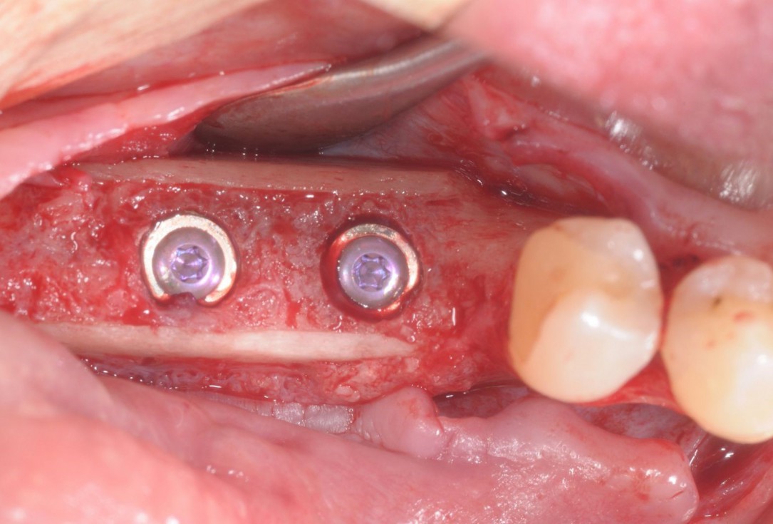 Three-dimensional augmentation with maxgraft® cortico - Dr. R. Würdinger