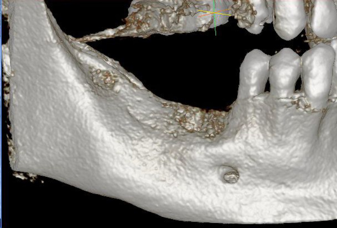 Three-dimensional augmentation with maxgraft® cortico - Dr. R. Würdinger
