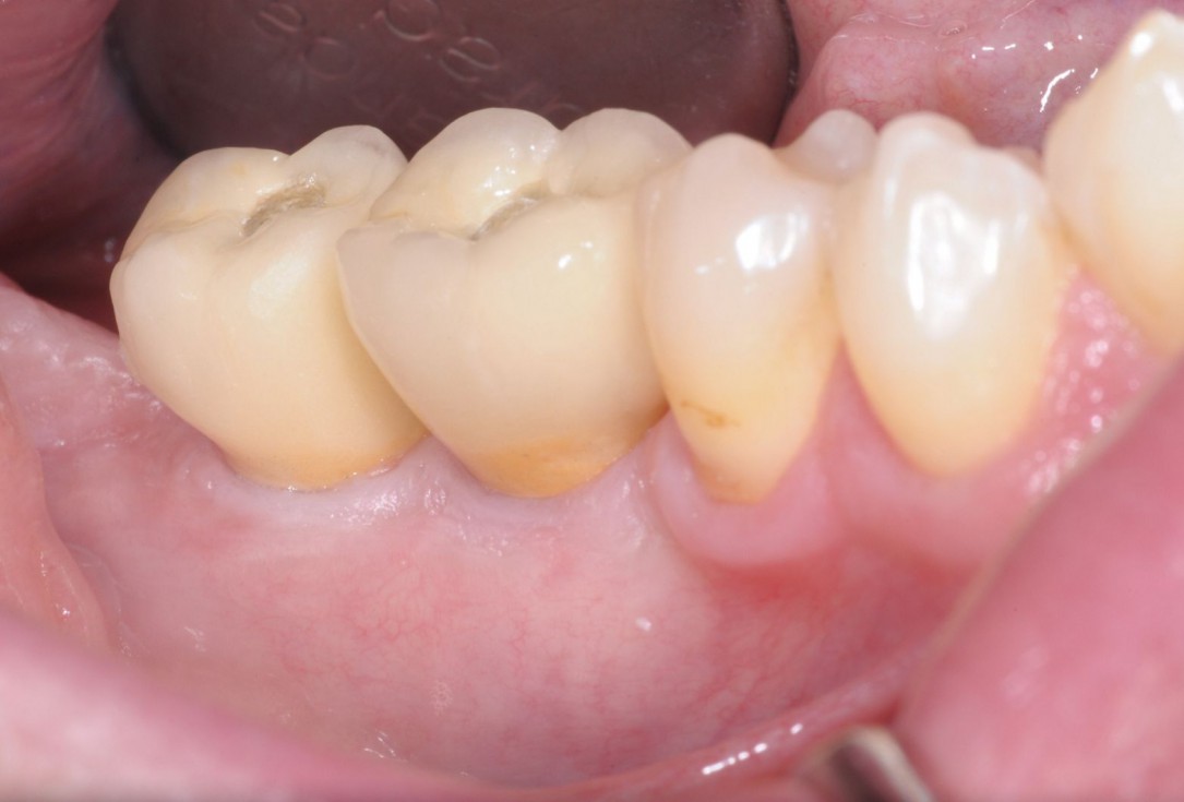 Three-dimensional augmentation with maxgraft® cortico - Dr. R. Würdinger