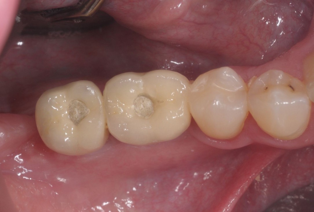 Three-dimensional augmentation with maxgraft® cortico - Dr. R. Würdinger