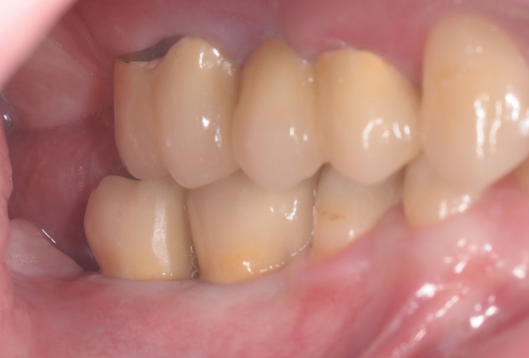 Three-dimensional augmentation with maxgraft® cortico - Dr. R. Würdinger