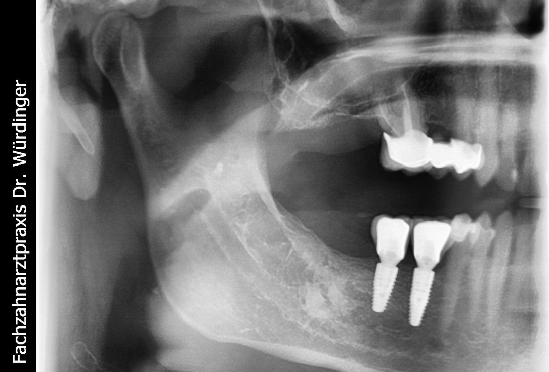 Three-dimensional augmentation with maxgraft® cortico - Dr. R. Würdinger