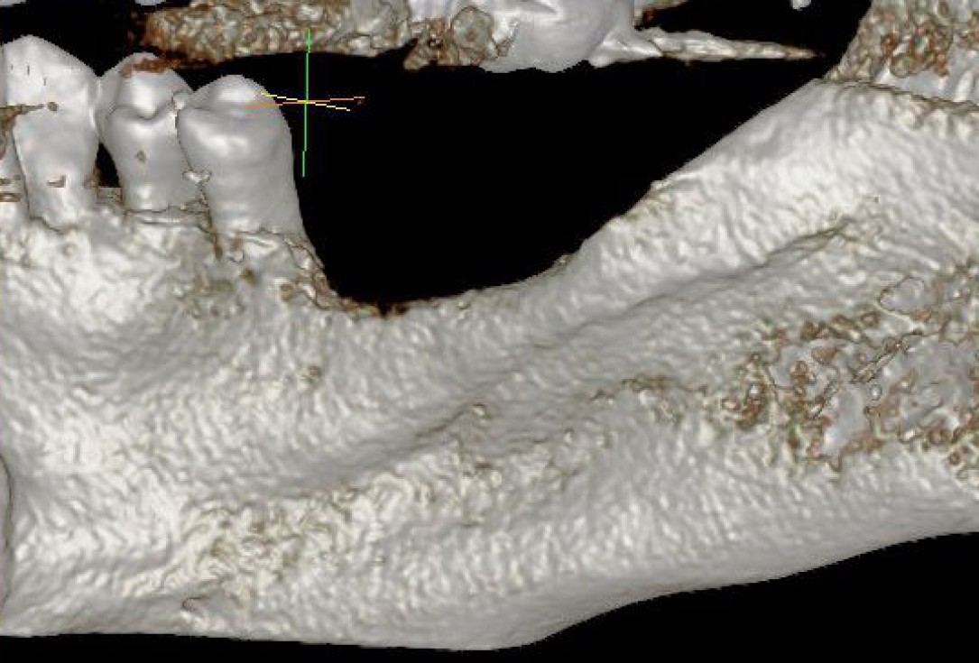 Three-dimensional augmentation with maxgraft® cortico - Dr. R. Würdinger