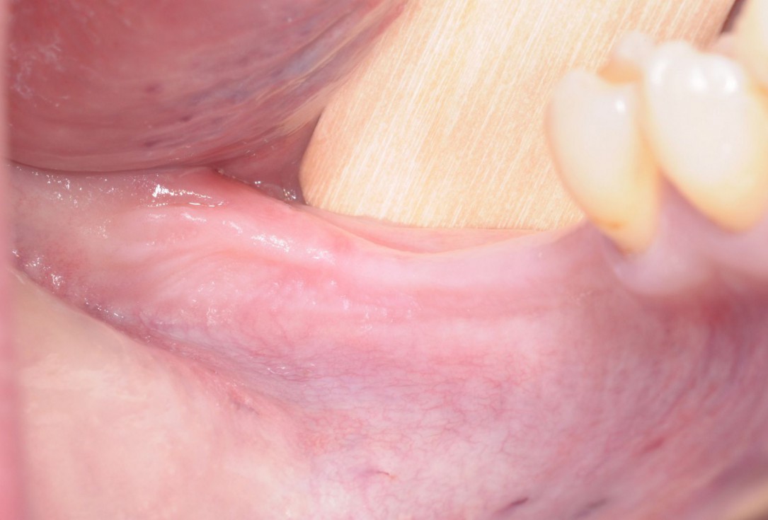 Three-dimensional augmentation with maxgraft® cortico - Dr. R. Würdinger